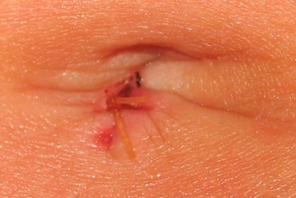 The stitch in Syrena's Belly Button