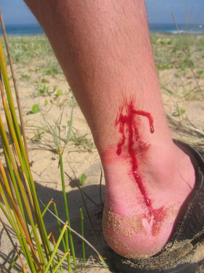 Sucker Wound