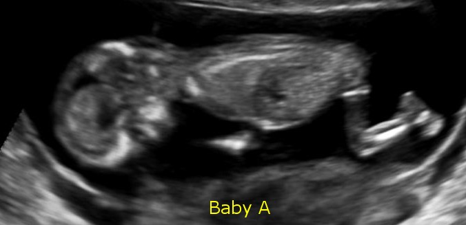 Baby A