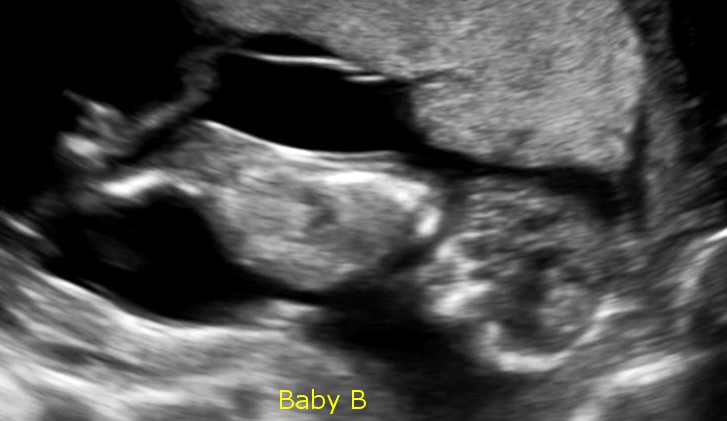 Baby B