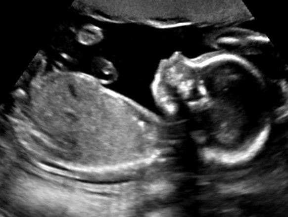 Baby A
