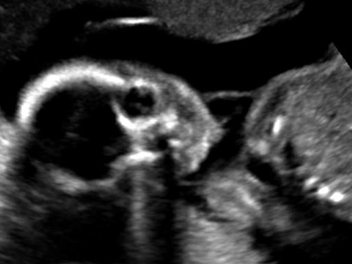 Baby B