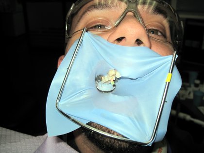 Me getting a root canal